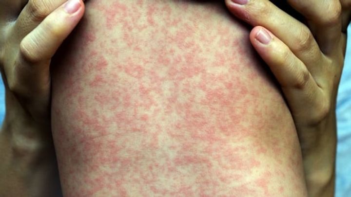 Measles 'out of control,' experts warn, as Alberta case counts surpass 1k