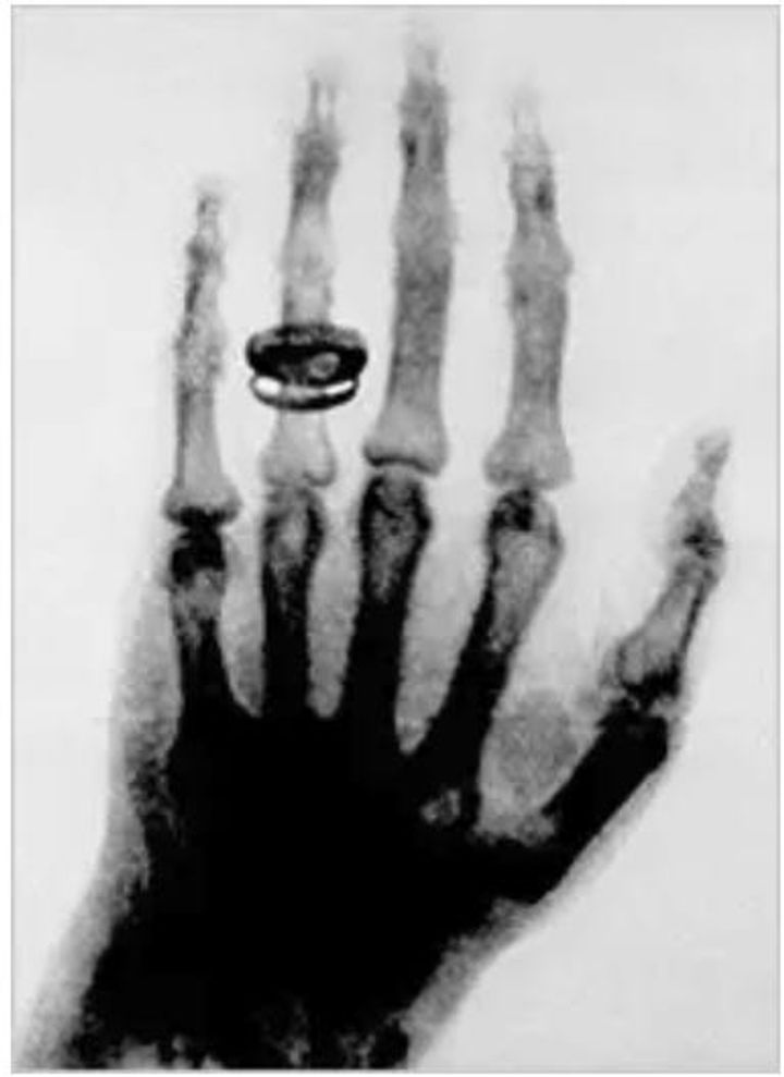 How did X-Rays gain mass adoption?