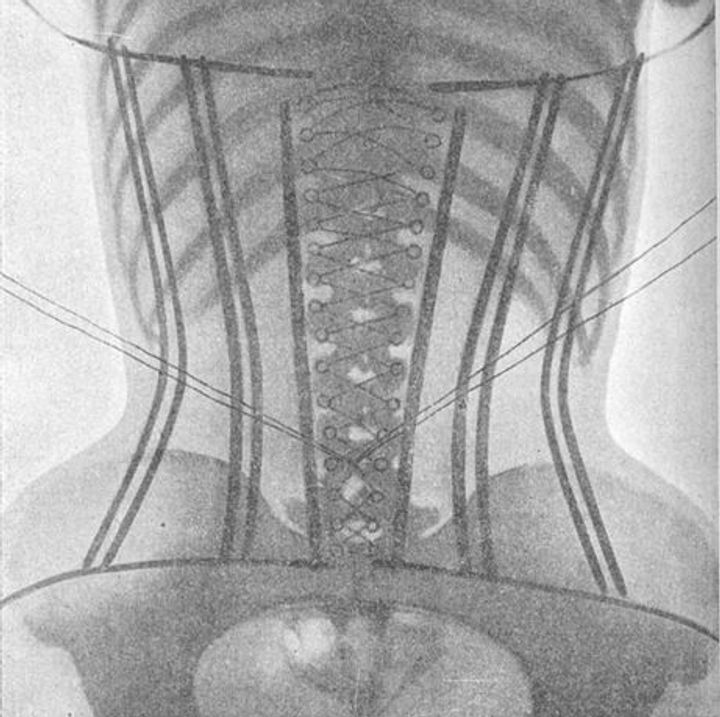 The Corset X-Rays of Dr Ludovic O'Followell (1908)