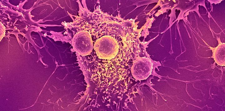 Covid-19 mRNA vaccines trigger the immune system to recognize and kill cancer