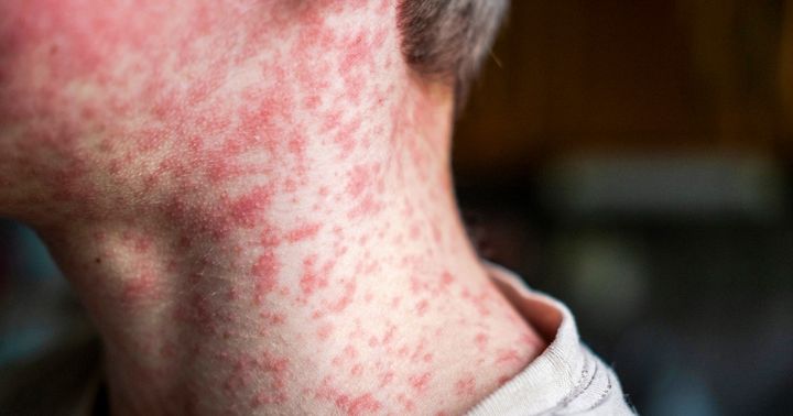New measles cases in S. Carolina put U.S. at risk of losing elimination status