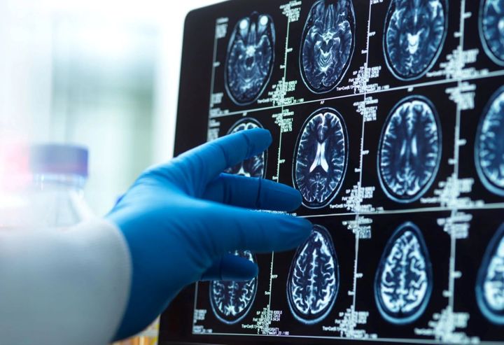 Covid-19 leaves a lasting mark on the human brain