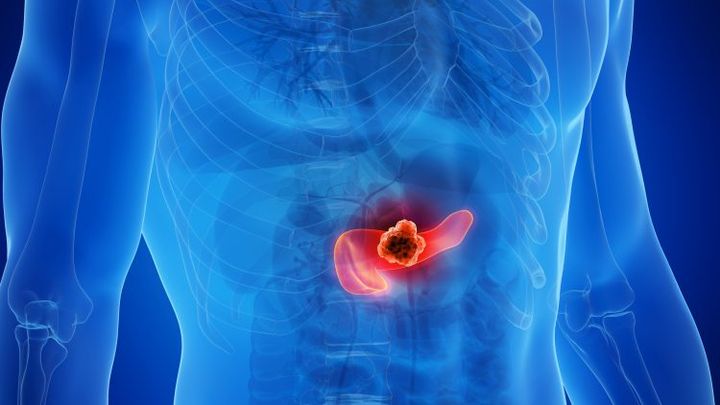 Drug trio found to block tumour resistance in pancreatic cancer