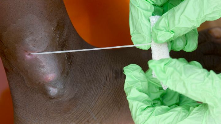 Guinea worm on track to be 2nd eradicated human disease; only 10 cases in 2025