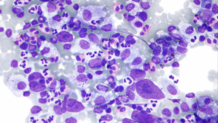 Lymphoma Treatment Reaches 100% Survival Rates in Large-Scale Study