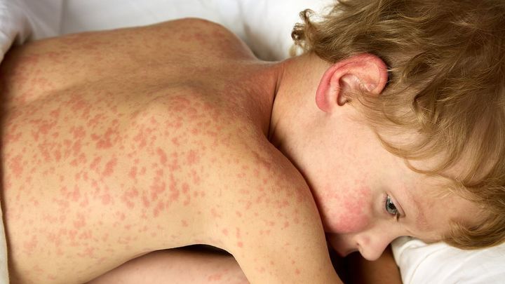 Hundreds quarantined as measles outbreak accelerates in the South